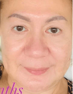 female face after